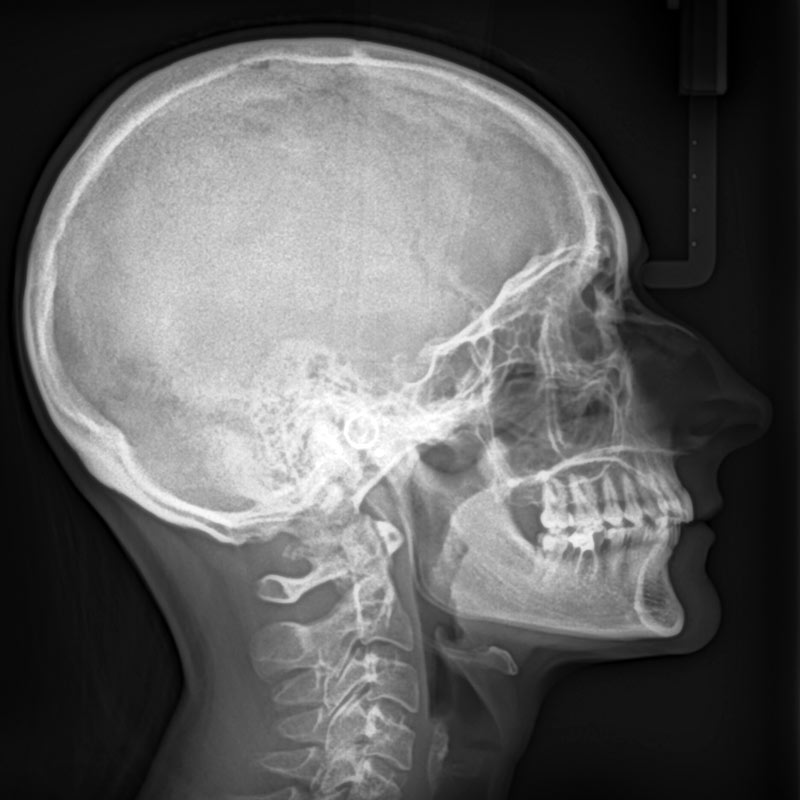 Radiographie de profil