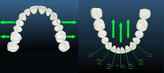 le Set Up virtuel dynamique en Orthodontie
